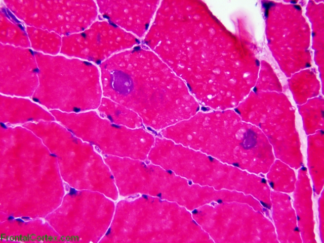 Tubular Aggregates H&E stain