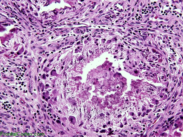 Tumoral calcinosis, H&E stain x 200