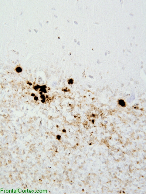 Sporadic Jakob-Creutzfeldt disease, VV2 subtype, cerebellum, 3F4 immunohistochemical staining