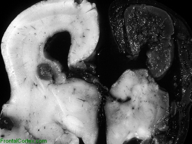 Unilateral hemorrhagic necrosis involving right cerebral hemisphere, coronal section