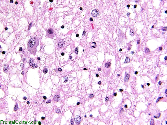 Vanishing White matter disease, thalamus, H&E stain section