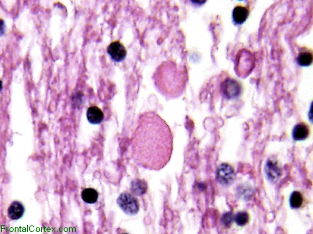 Vanishing White matter disease, H&E stain, high power