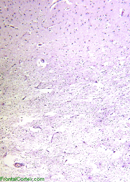 Vanishing white matter disease, cerebral cortex and white matter, H&E stain x 40