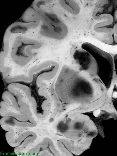 Arterial border zone ("watershed") infarcts, coronal section through basal ganglia