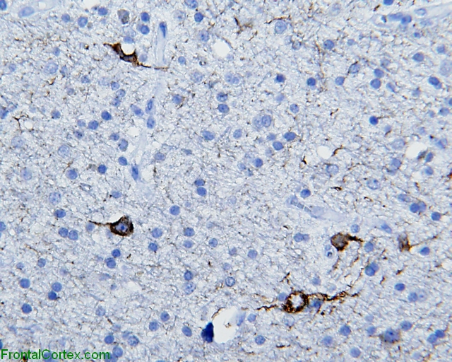 White Matter Neurons, neurofilament immunohistochemical stain