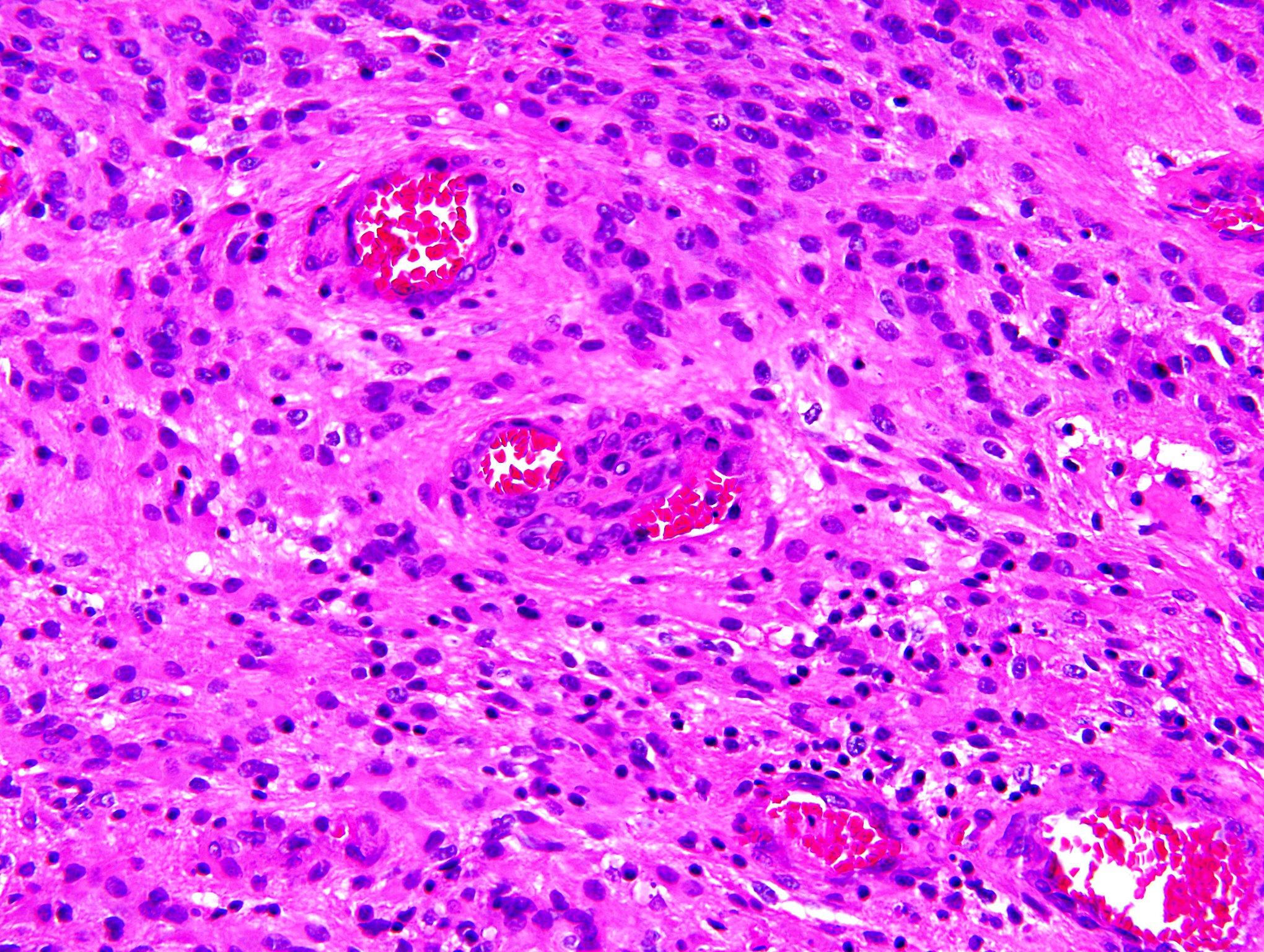 Anaplastic ependymoma, microvascular proliferation.