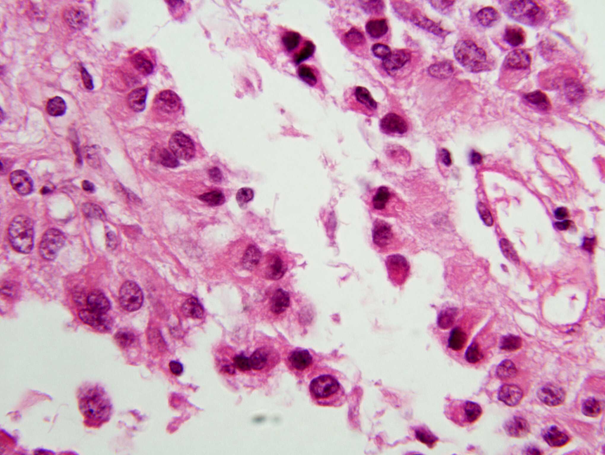 Astroblastomatous rosettes, H&E stain X 600