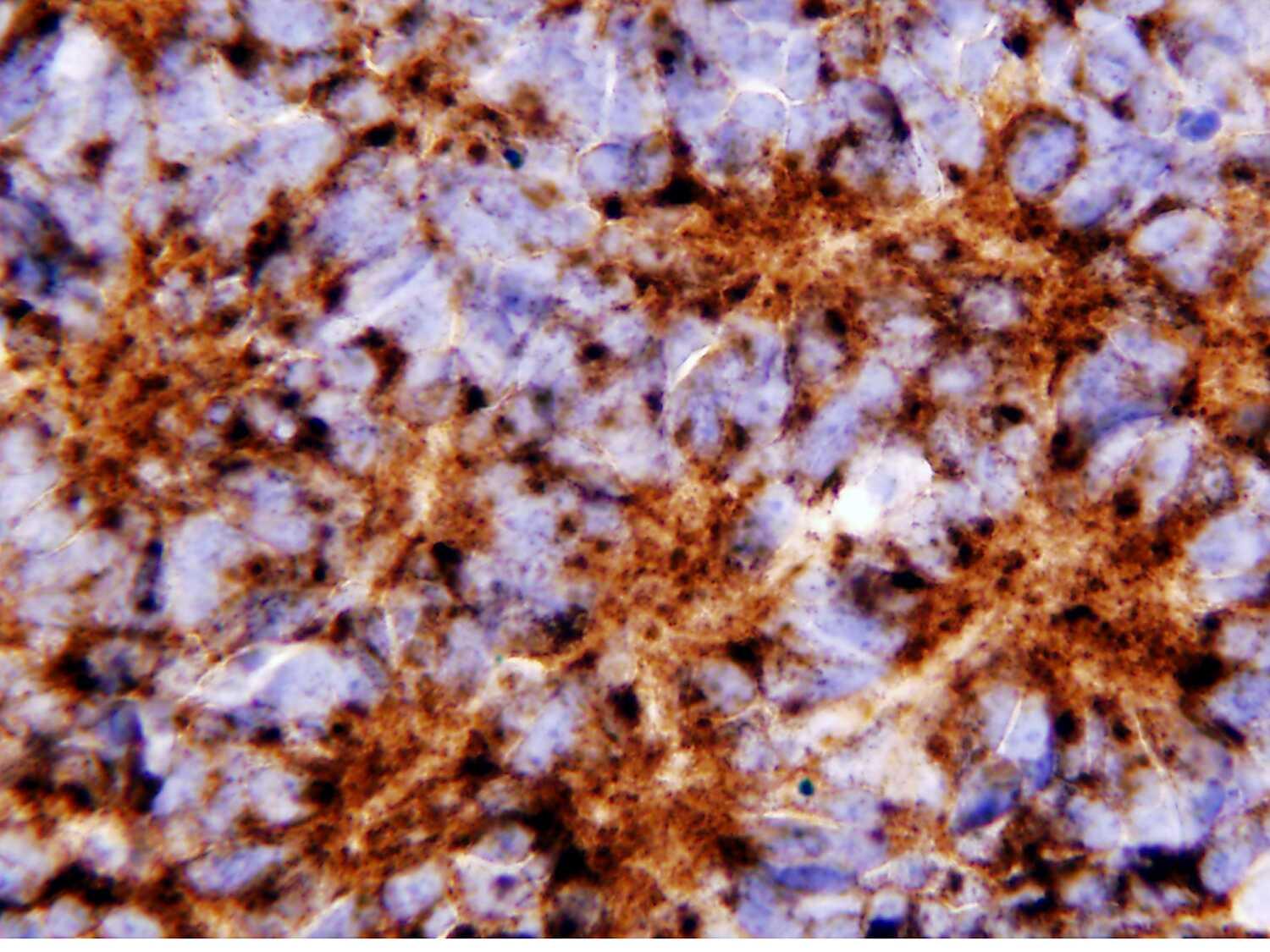 Homer Wright rosettes, synaptophysin immunohistochemical staining x 200