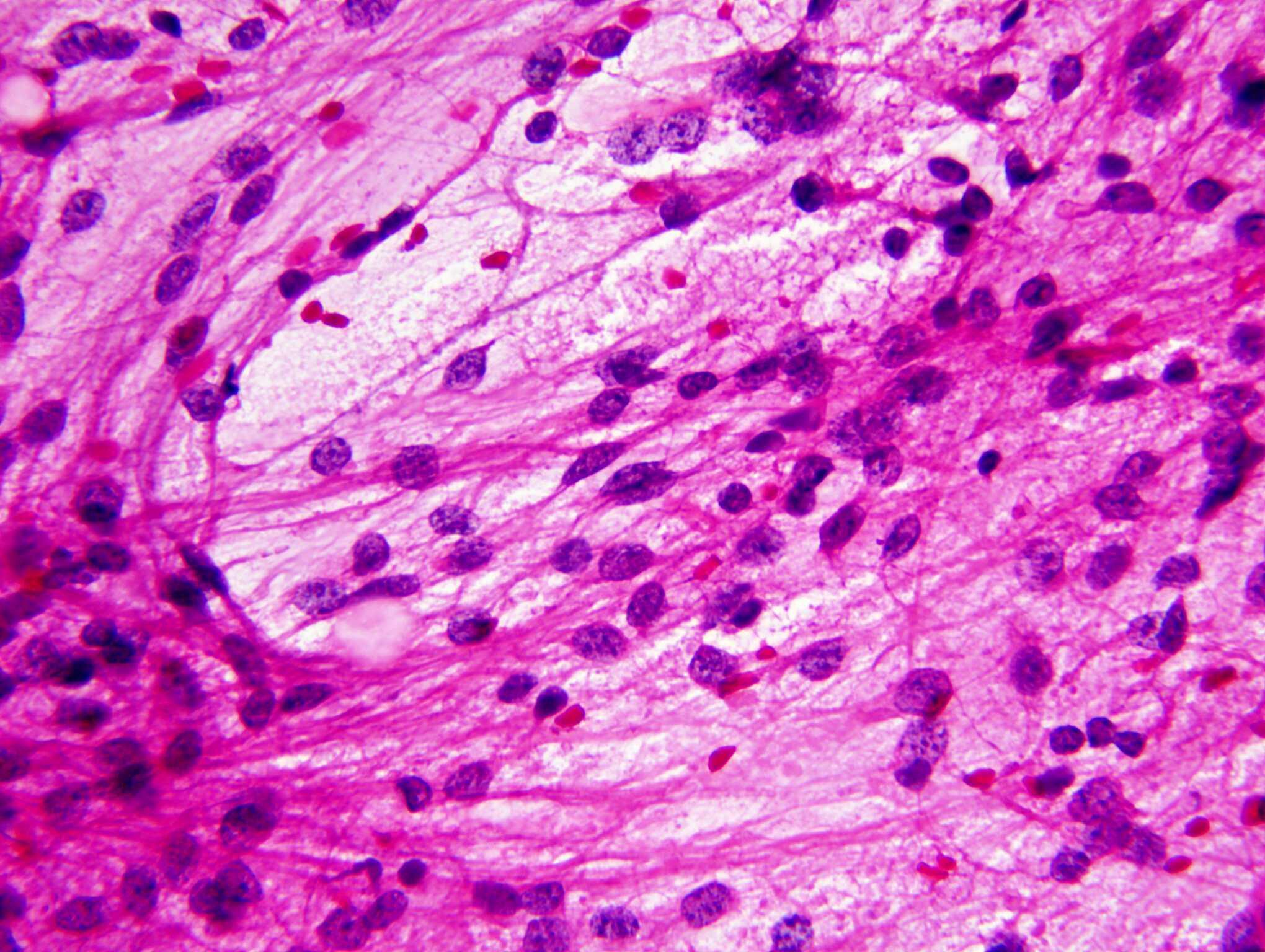 Pilocytic astrocytoma, intraoperative smear preparation.