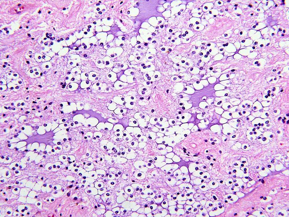 Rosetted glial neuronal tumor of the fourth ventricle, H&E x 200