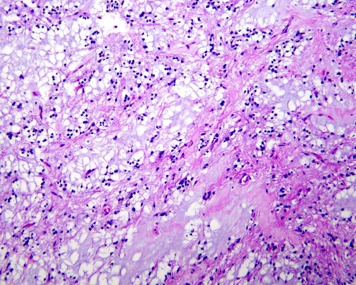 Rosetted glioneuronal tumor of the fourth ventricle, low power view