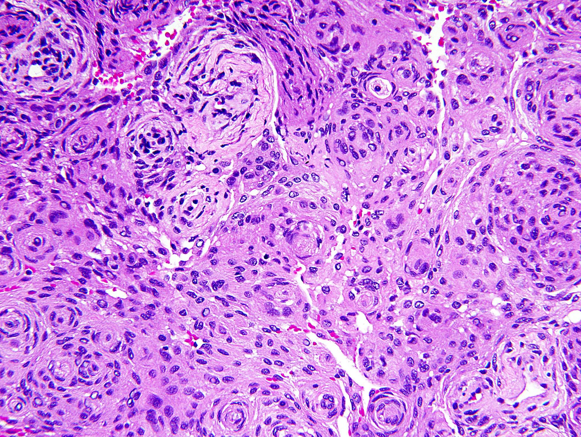 Meningioma, H&E stain x 200