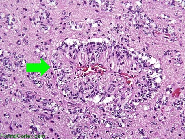 Angiocentric glioma x400 with arrow