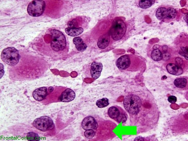 Atypical Teratoid Rhabdoid Tumor, intraoperative smear preparation x 600 (H&E stain). with arrow