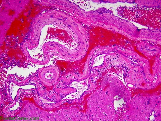 amyloid Angiopathy