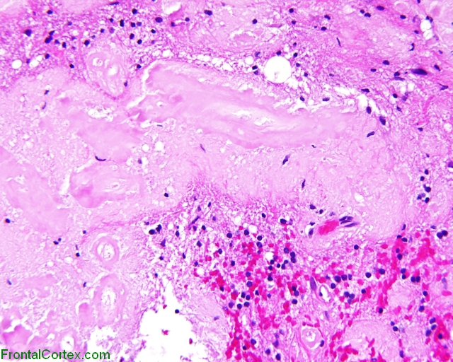 Amyloidoma, cerebral parenchyma, H&E stain.