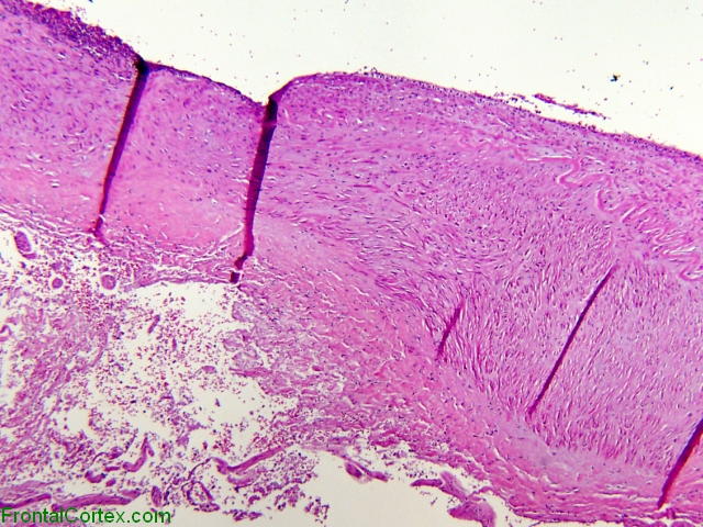 Aneurysm wall, H&E stained slide x 40