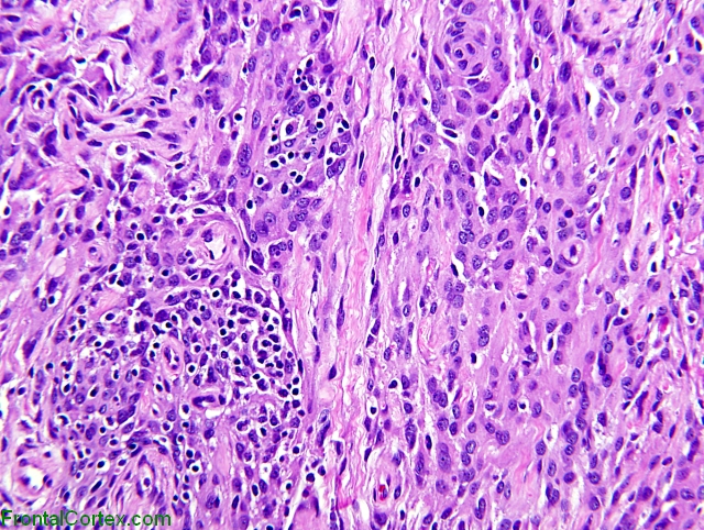 Atypical meningioma, H&E stained section.