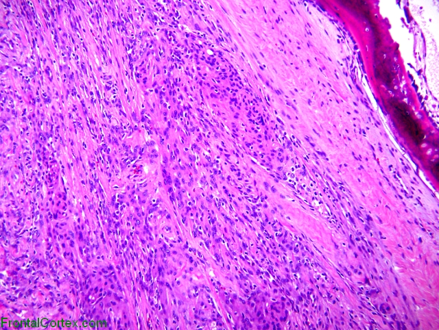 Atypical meningioma invading bone