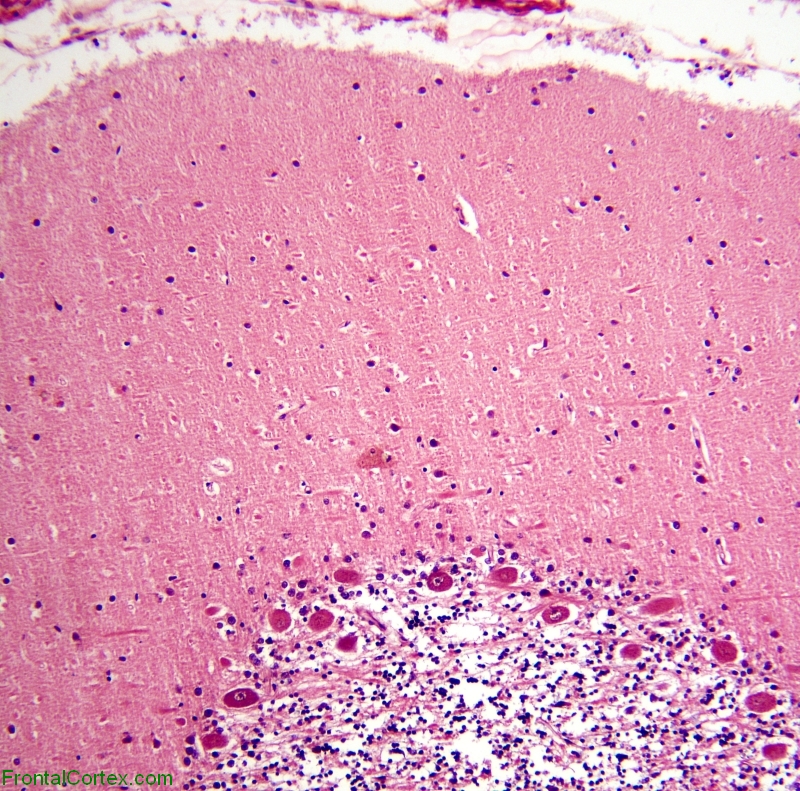 Normal Cerebellum