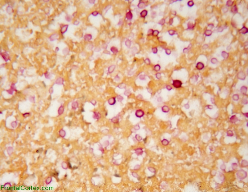 Cryptococcoma, mucicarmine staining, high power