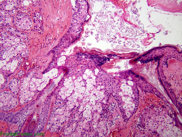 Dermoid cyst, high power H&E stain