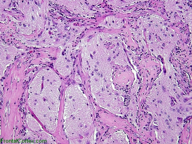 Menigioangiomatosis, H&E stain x 40