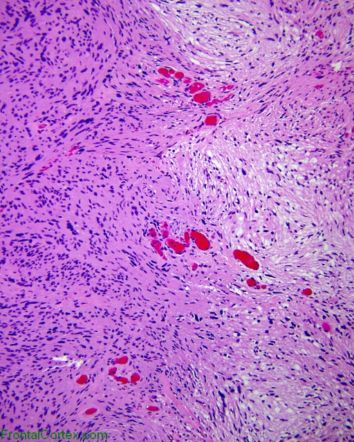 schwannoma