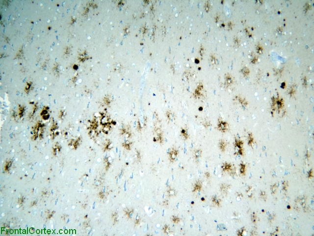 Variant Jakob-Creutzfeldt disease,  cerebral cortex, 3F4 immunohistochemical staining x 100