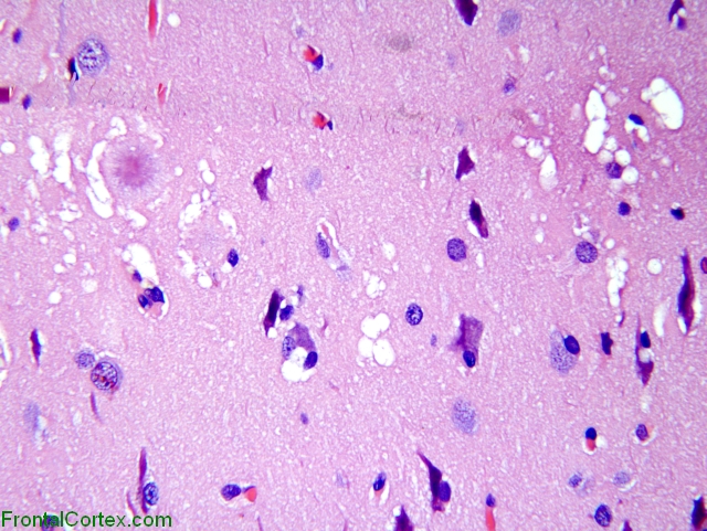 Variant Jakob-Creutzfeldt disease, H&E stained section of cerebral cortex x 200