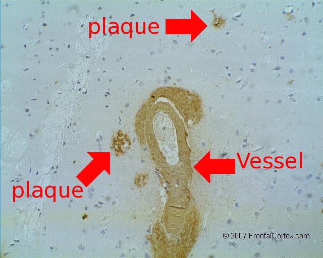 Amyloid Angiopathy Labeled