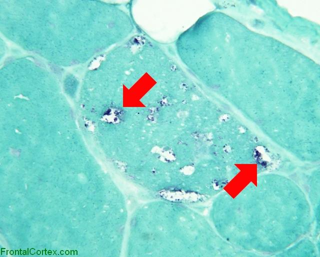 Trichrome IBM hp Inclusions