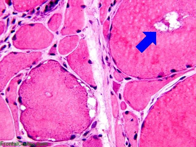 Inclusion body myositis x400 with arrow