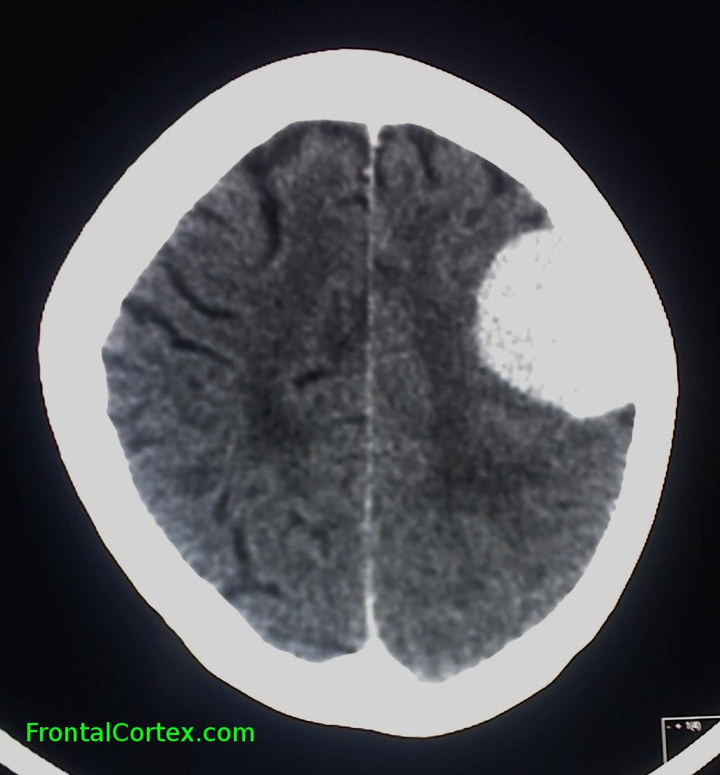 Meningioma - Contrast CT