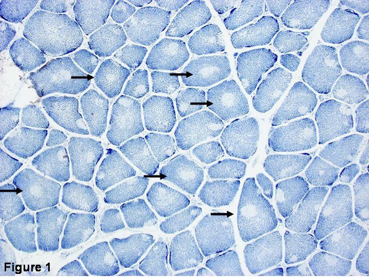 NADH stained skeletal muscle from a patient with CCD.