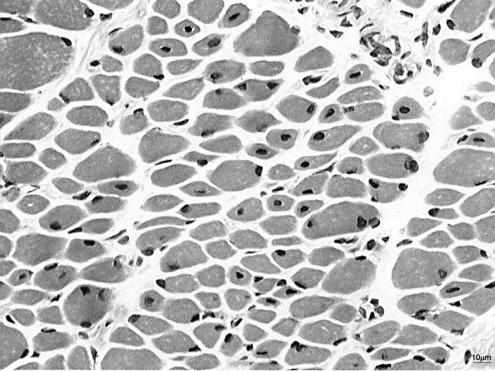 Centronuclear Myopathy