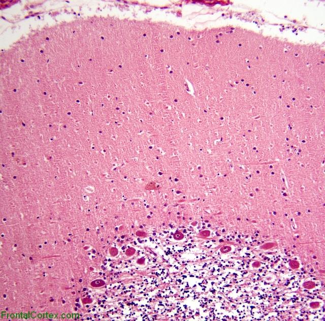 Normal Cerebellum for Comparison