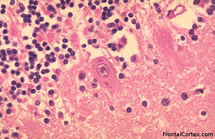 Rabies encephalitis, Negri bodies within the cytoplasm of cerebellar Purkinje cell neurons.