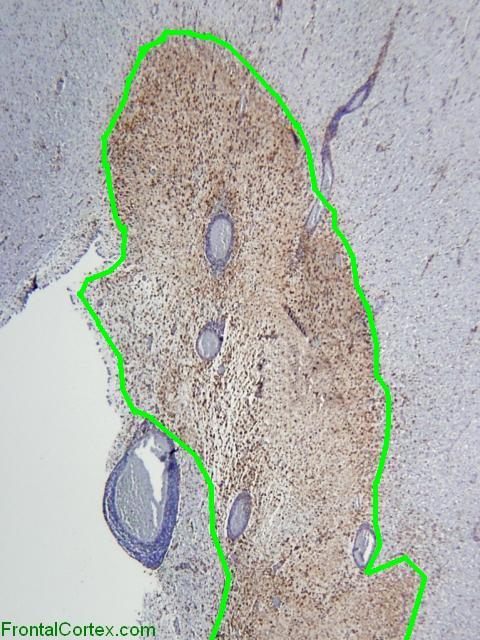 Perivent Plaque CD68 IHC - Outlined