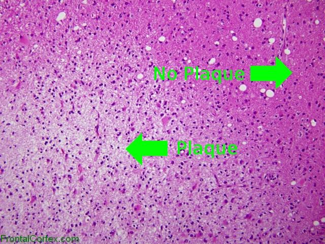 Tumefactive demyelination, low power H&E stained section labeled