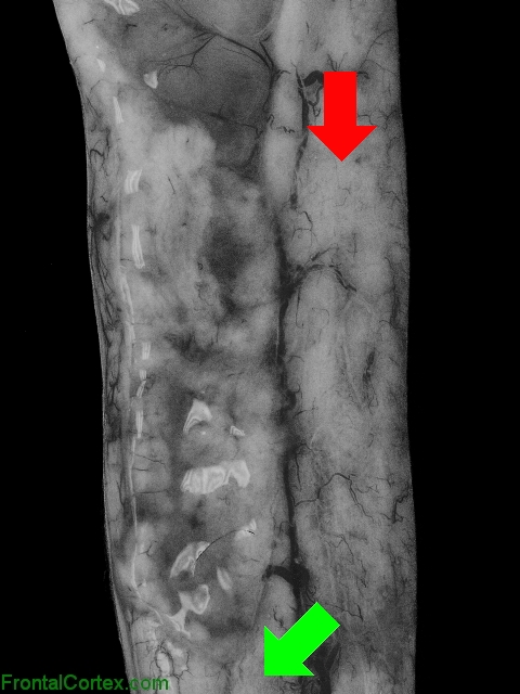 Longitudinally extensive transverse myelitis, extending into caudal brainstem, mid sagittal section of brain with arrows