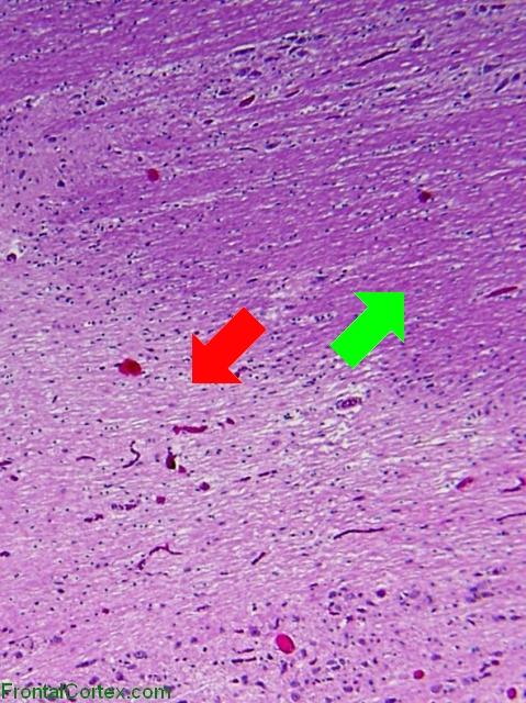 Inactive demyelinated plaque, H&E stain section