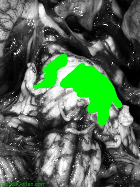 Multiple Sclerosis, ventral surface of brainstem, shaded