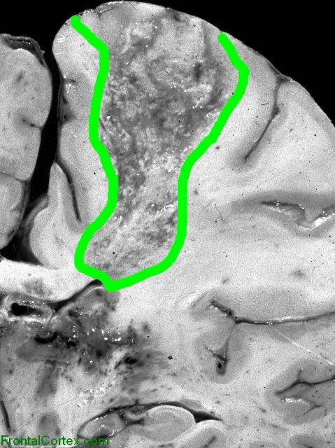 Demyelinative plaque, status post irradiation, coronal section, with outline