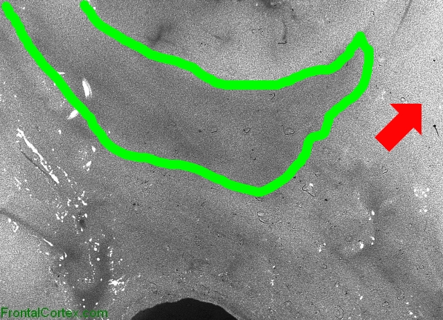 Alexander disease, coronal section, close-up view, highlighted