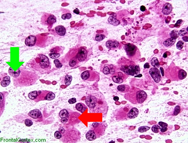 Atypical teratoid/rhabdoid tumor, intraoperative smear preparation x 400 (H&E stain) with arrows