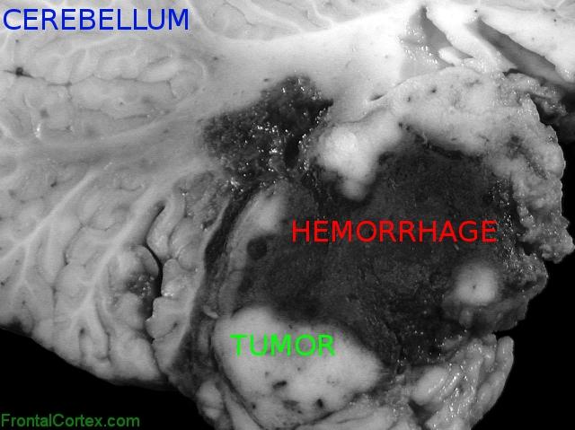 Atypical teratoid/rhabdoid tumor, sagittal section through cerebellum and brainstem, close-up, labeled