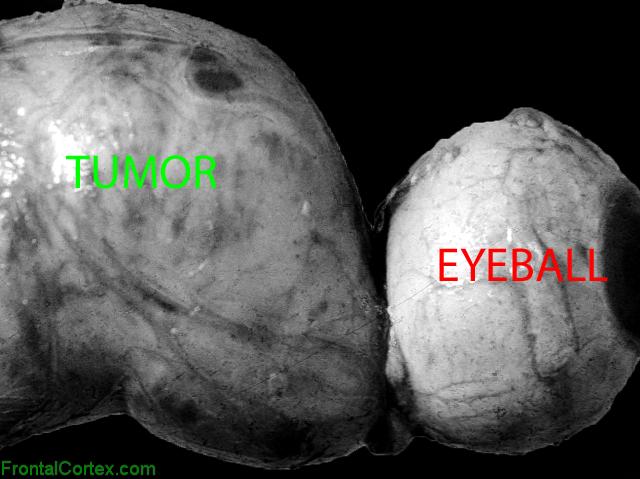 Optic Glioma Gross, Labeled