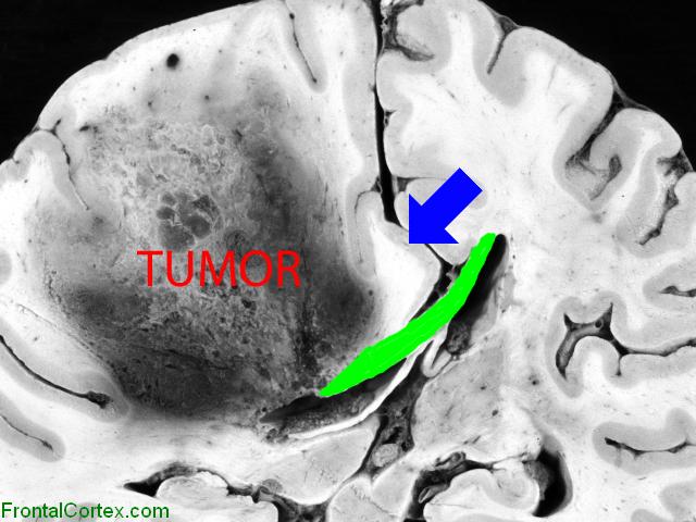 Glioblastoma multiforme, coronal section at level of posterior thalamus, labeled