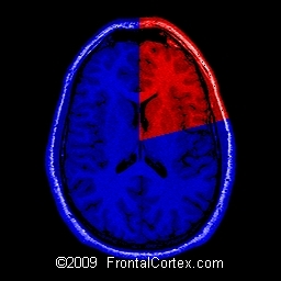 Stroke Pie Chart